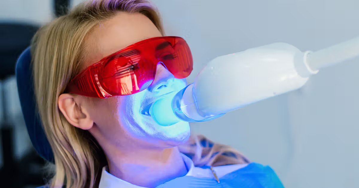 Veneers